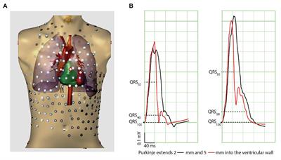 Why Ablation of Sites With Purkinje Activation Is Antiarrhythmic: The Interplay Between Fast Activation and Arrhythmogenesis